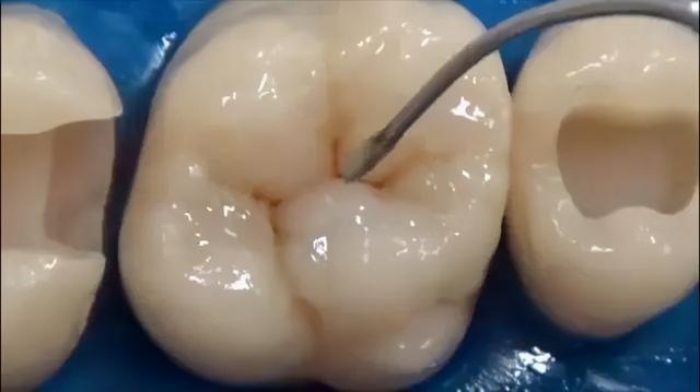 网上卖的补牙材料能用吗网上卖的补牙材料能用吗？全面解读牙齿修复材料的选择与使用